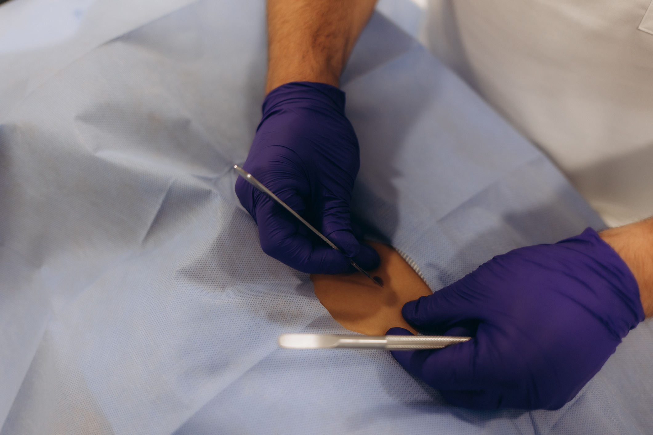 Image of skin tumor being removed from the body